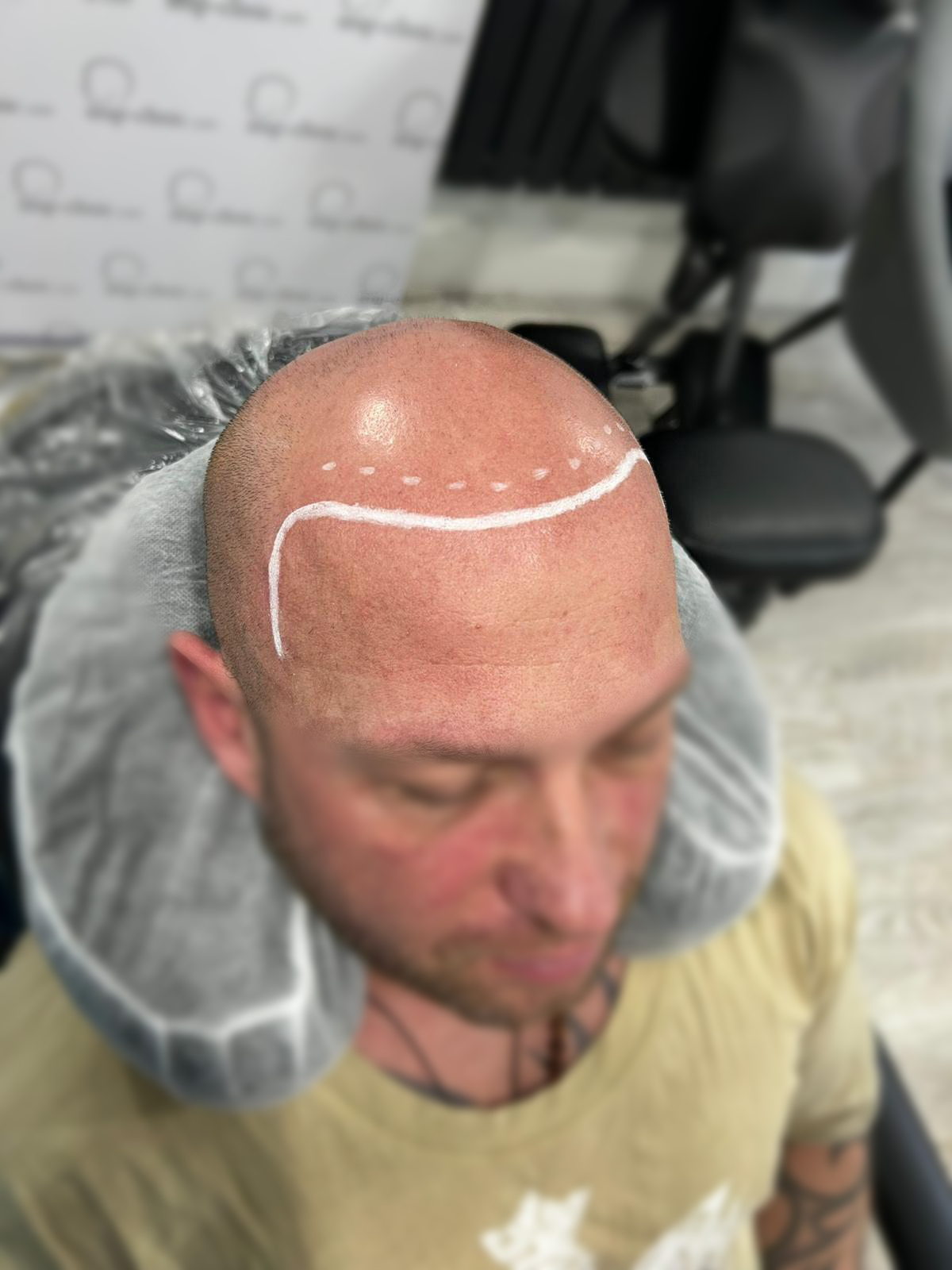 Before SMP - Hairline Design