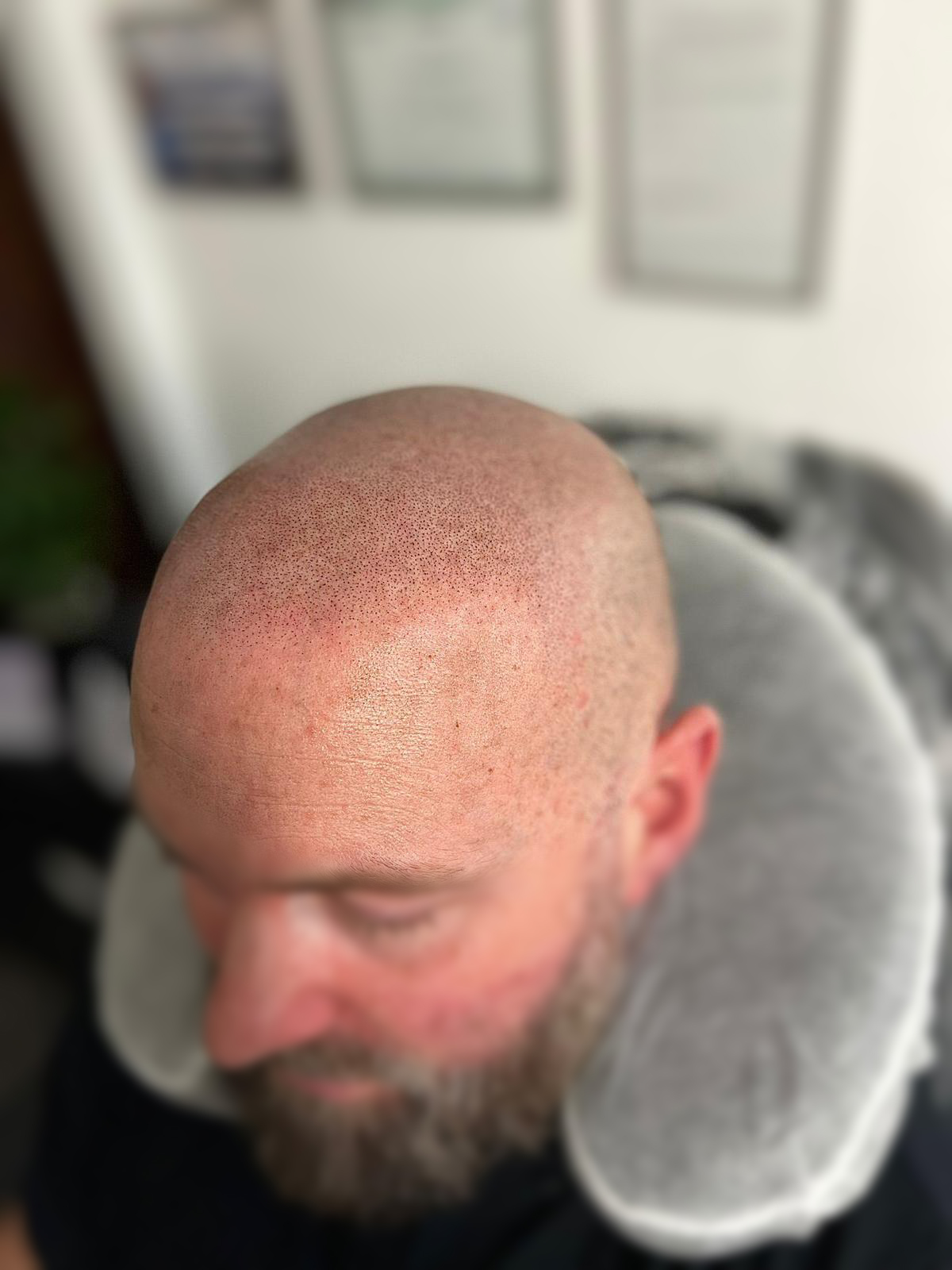 After SMP - Side Profile