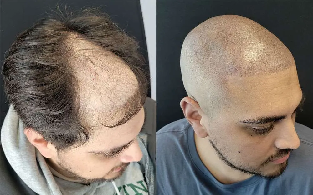 Alopecia Treatment