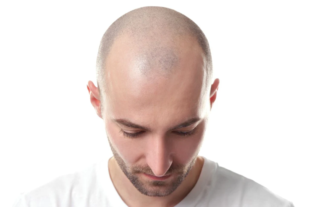 Before SMP Treatment